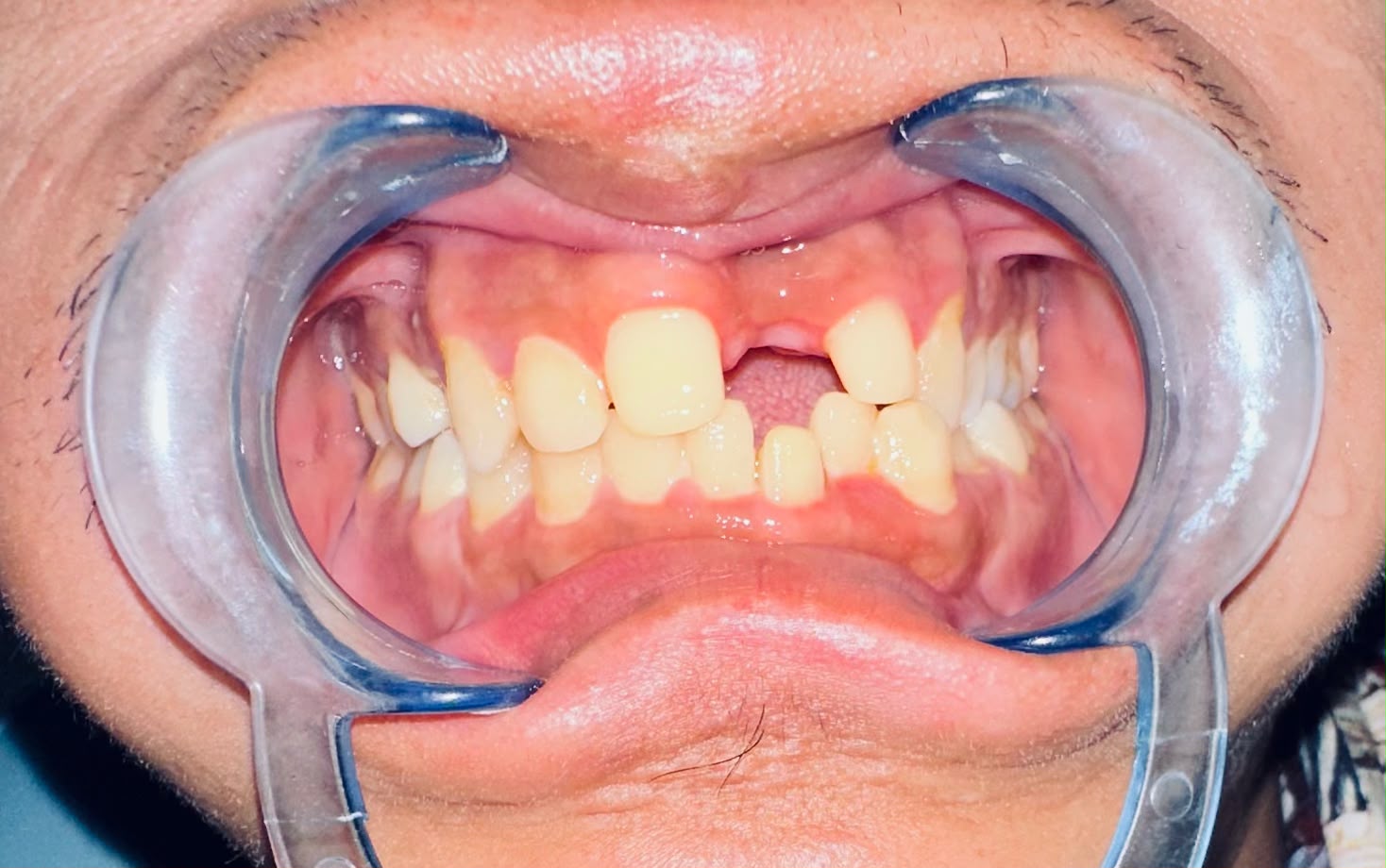 Before: missing front tooth (real clinic case photo)
