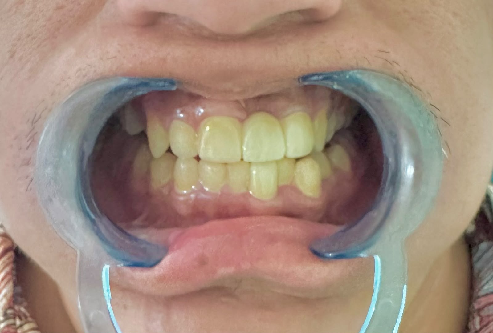 After: restored smile from a real dental case treated at Gentle Dental Studio, Bharatpur